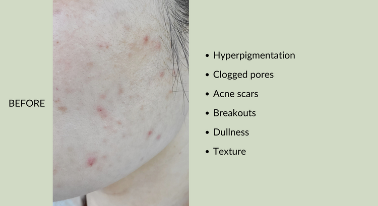 hyperpigmentation face